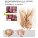 NailRenew - Schnelle Nagelreparaturbehandlung für stärkere und gesündere Nägel